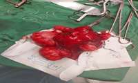 عمل جراحی هیسترکتومی به همراه میوم های متعدد خانم۴۶ ساله در مرکز آموزشی، پژوهشی و درمانی دکتر شریعتی بندرعباس